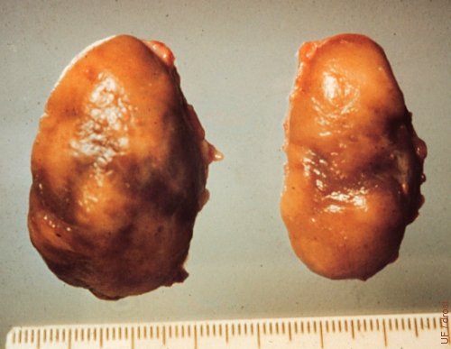 Interstitial Cell Tumor.