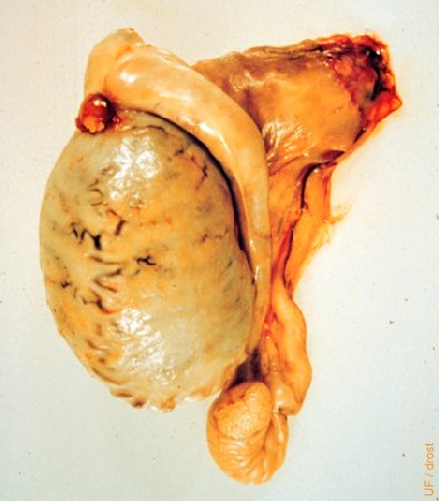 Appendix Testis.