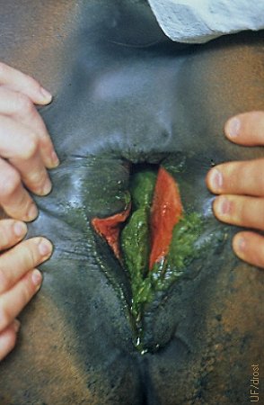 Third-degree Perineal Laceration.