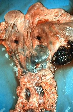 Ruptured Hematoma in Broad Ligament.