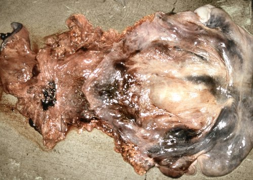 Necrotic Uterus after Torsion.