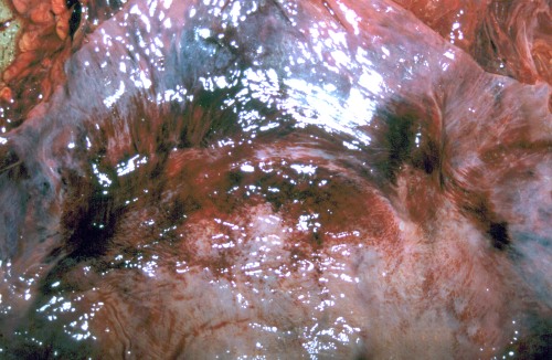 Bruised Uterus - Close Up.