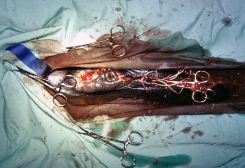 Perineal Laceration Surgery.