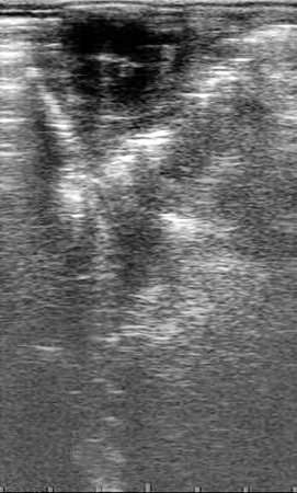 GCT - Contralateral Ovary.