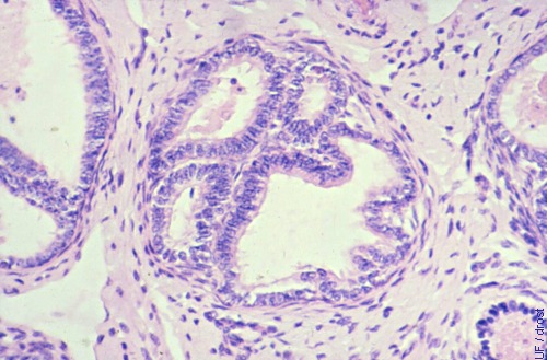 Periglandular Fibrosis.