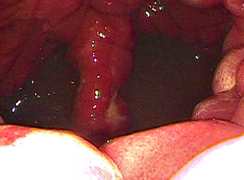Urine Pooling in the Uterus.