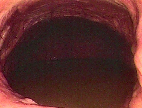 Vaginal Endoscopy.