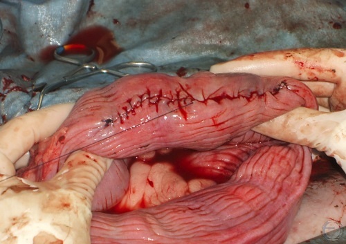 Uterine Closure after C-Section.