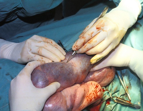 Uterine Incision.