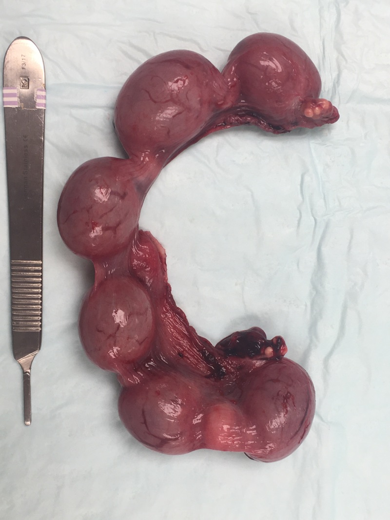 Gravid Uterus