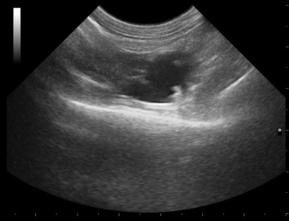 Ultrasound of Ovarian Cyst