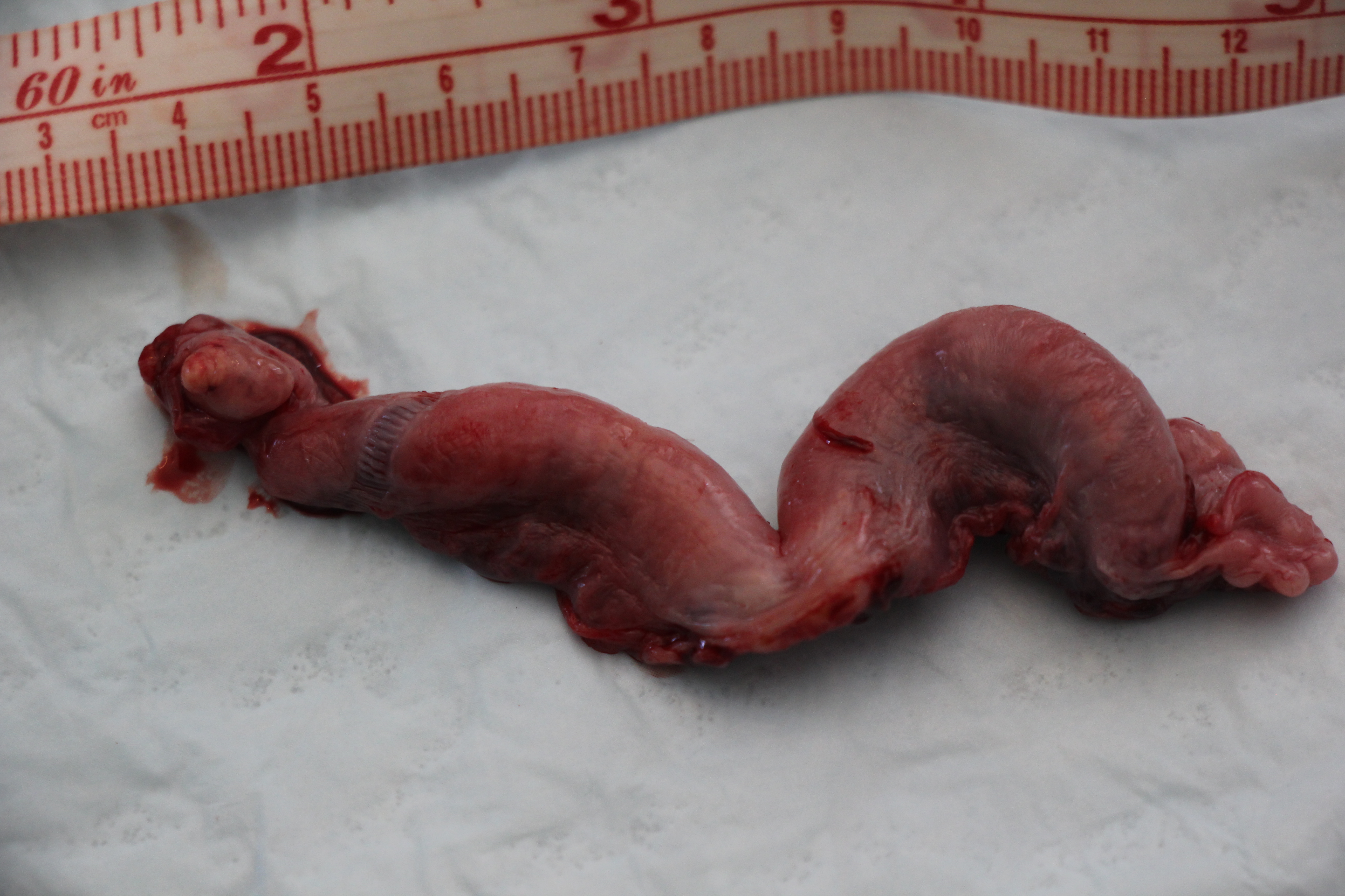 Postpartum Uterus
