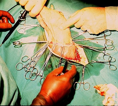 Fetal Surgery.