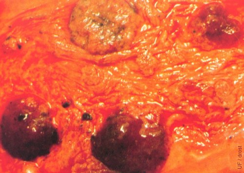 Chlamydial Lesions.