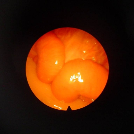 Laparoscopic View of Uterus.