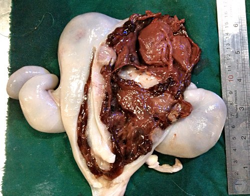 Uterus Containing Mummy.
