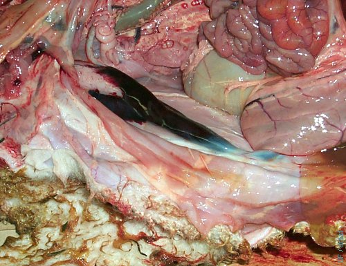 Umbilical Artery Hemorrhage.