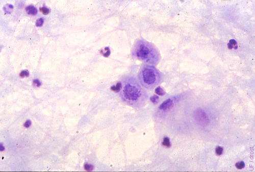 White Blood Cells in Semen.