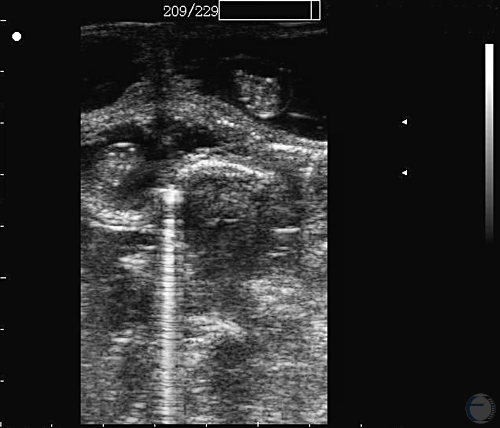 Ultrasonogram at 30 Days - Twins.