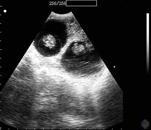 Ultrasonogram at 30 Days - Twins.
