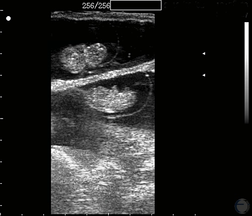 Ultrasonogram of 35 Days - Twins.