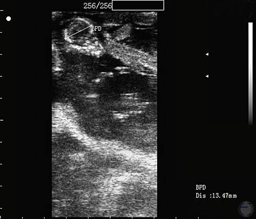 Ultrasonogram at 38 Days.