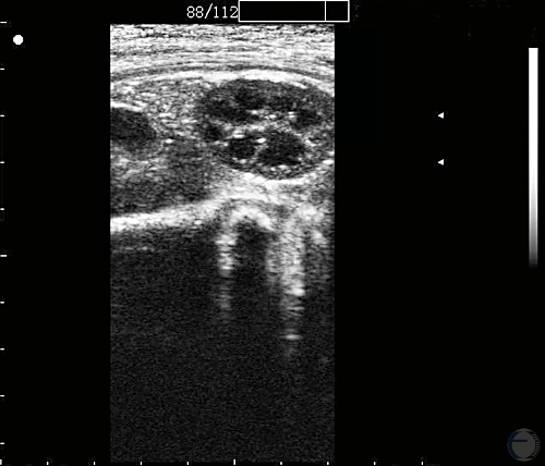 Ultrasonogram Fetal Kidney at 80 Days.