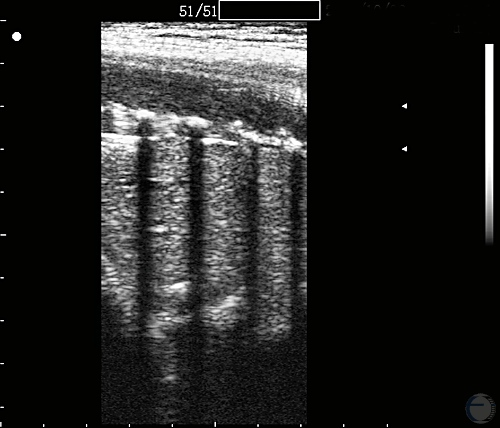 Ultrasonogram Fetal Ribs at 140 Days.