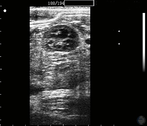 Ultrasonogram Fetal Kidney at 140 Days.