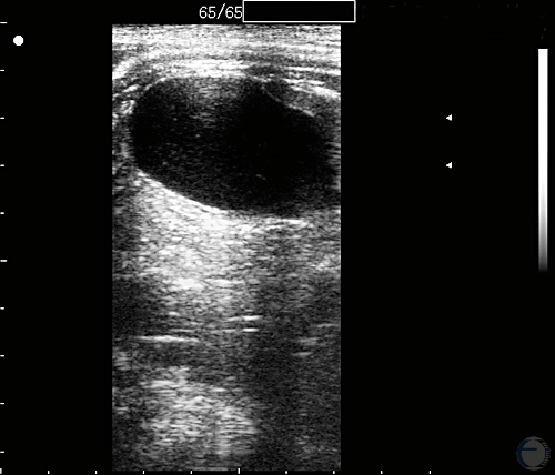 Fetal Urinary Bladder at 140 Days.