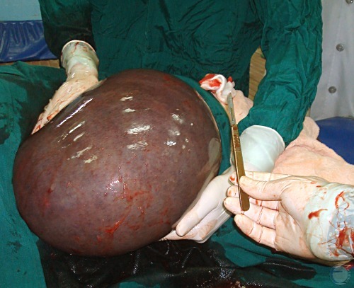 Torqued Uterus.
