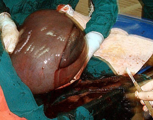 Incision of the Uterus.