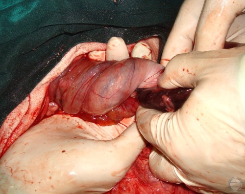 Twisted Body of the Uterus.