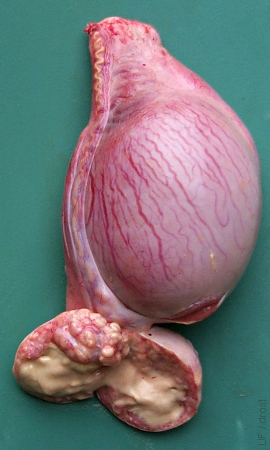 Distended Cauda after Vasectomy.