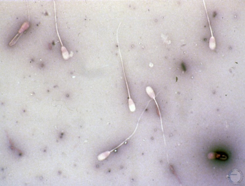 Boar Spermatozoa with Bent Tail.