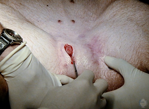 Incision over the Testicle.
