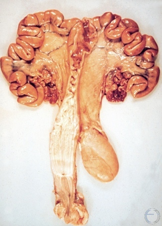 Tortuous Cervix.