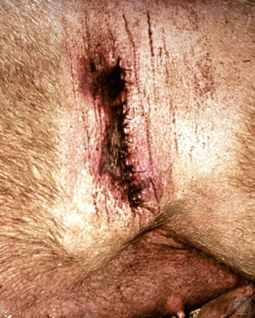 Infected Incision.