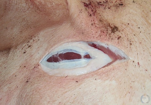 C-section - Skin Incision.