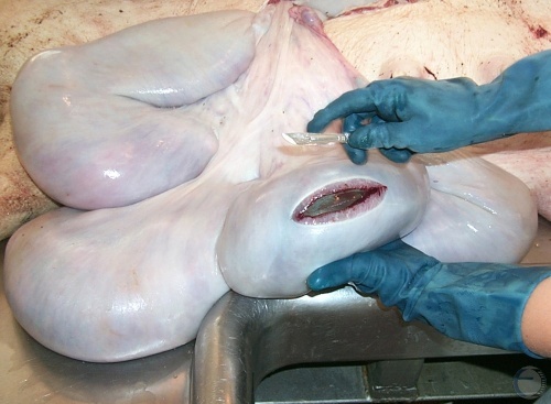 C-section - Uterine Incision.