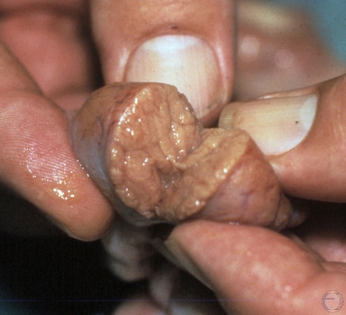 Testis of a Pregnant Hermaphrodite.