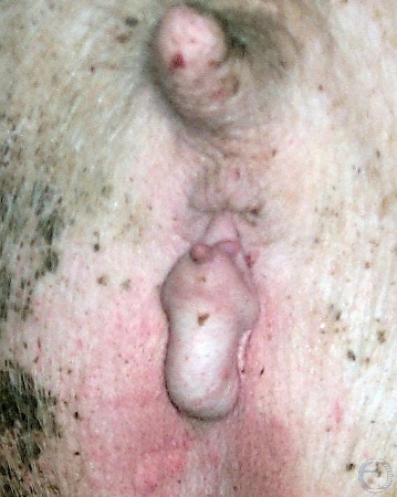 Intersex Vulva.