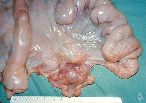 Ovarian Adhesions.