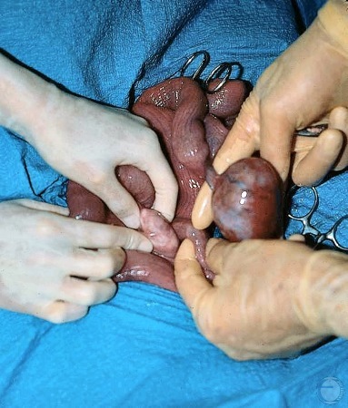 Ovarian Pathology.