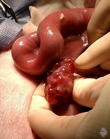 Normal Ovary with Multiple Follicles.