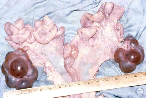 Large Hemorrhagic Cystic Follicles.