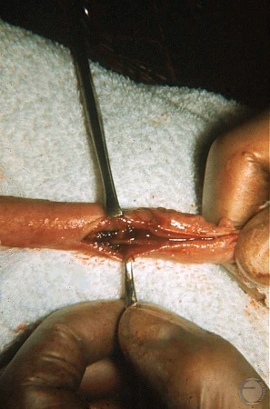 Urethral Hemorrhage.
