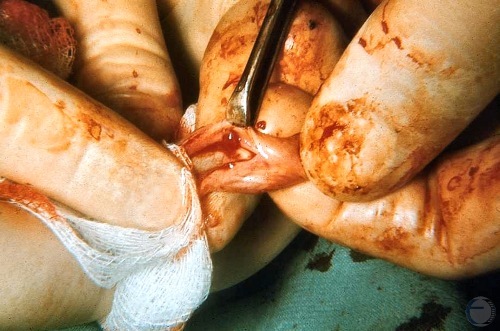 Vascular Urethral Polyp.