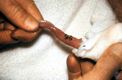 Removal of Urethral Polyp.