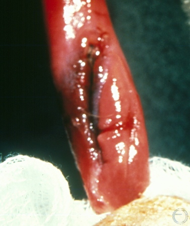 Penile Laceration - Close Up.